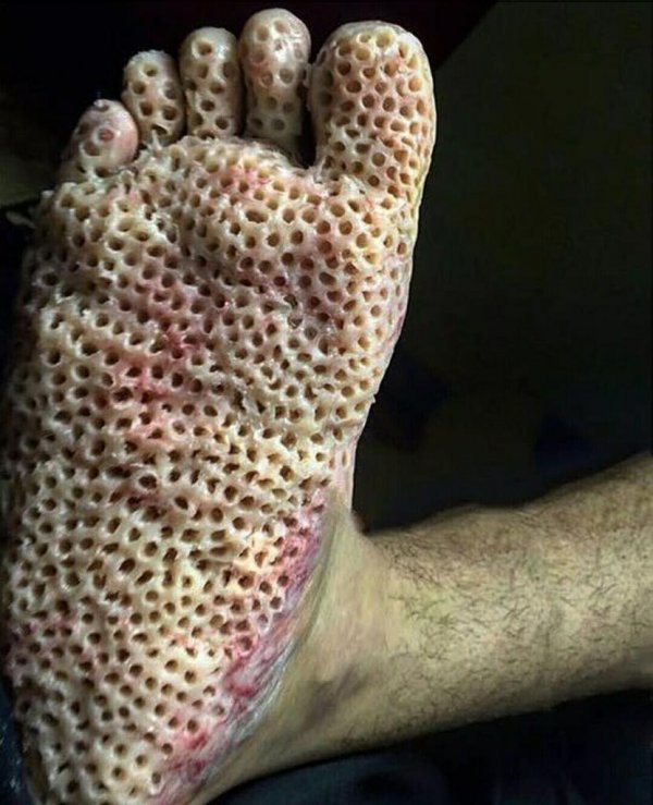 What is Trypophobia?- A Fear of Holes! Symptoms, Causes And Treatment